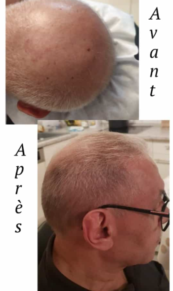 Montage HG Wellness hairs Montage HG Wellness hairs